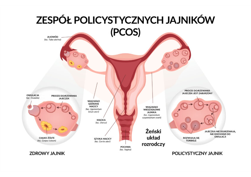 Schemat przedstawia zdrowy jajnik i jajnik dotknięty PCOS.