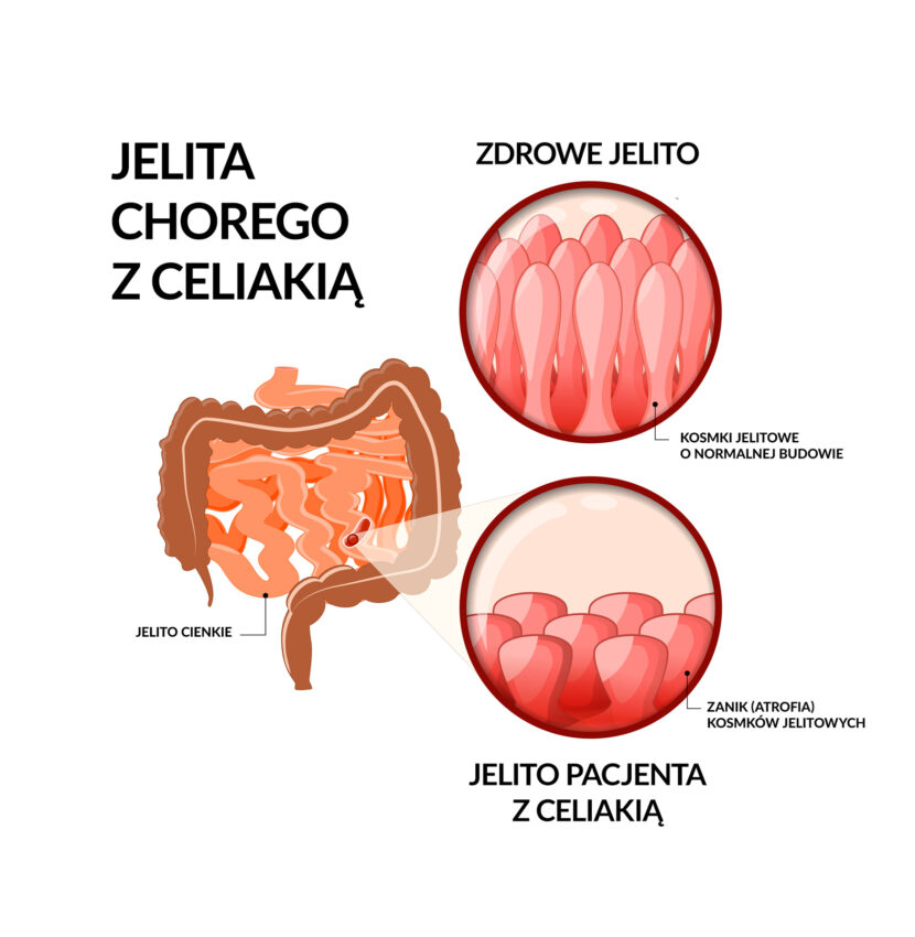 Na schemacie przedstawiono wygląd kosmków jelitowych jelita cienkiego u zdrowego i chorego dziecka.