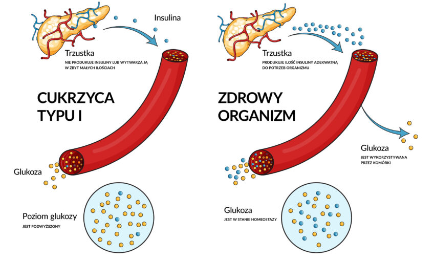 Ilustracja przedstawia schemat powstawania cukrzycy typu 1.