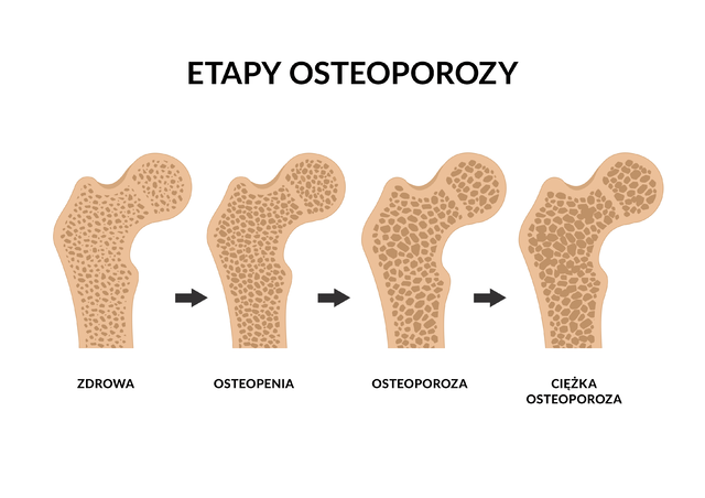 Schemat przedstawia kolejne etapy rozwoju osteoporozy.